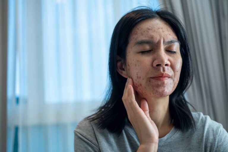 Jak pozbyć się trądziku domowymi sposobami? Leczenie trądzika w naturalny sposób