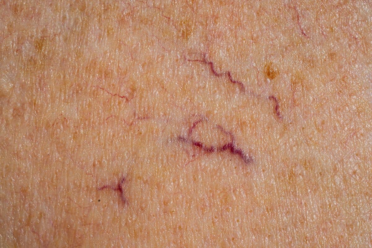 Skóra naczynkowa twarzy ukobiet